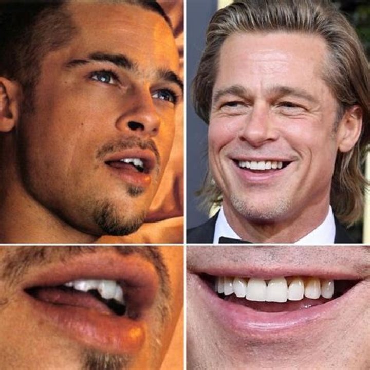 Pete Weber | What Happened | Teeth Before And After